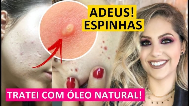 Leia mais sobre o artigo ACABEI COM ESPINHAS E CRAVOS USANDO ESSE ÓLEO NATURAL  – Gabriela Capone