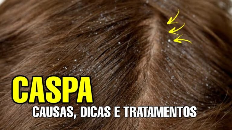 Leia mais sobre o artigo CASPA: CAUSAS, DICAS E TRATAMENTOS CASEIROS PARA TRATAR