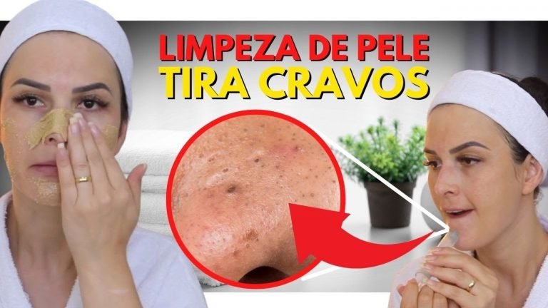 Leia mais sobre o artigo Remova Cravos Com Facilidade | Melhor Limpeza de Pele Caseira 🤍